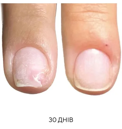 Regenerujący olejek na onycholizę Nails Of The Day, 15 ml